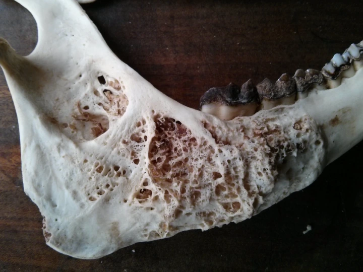 Afbeelding: Door Actinomycosis aangetaste kaak